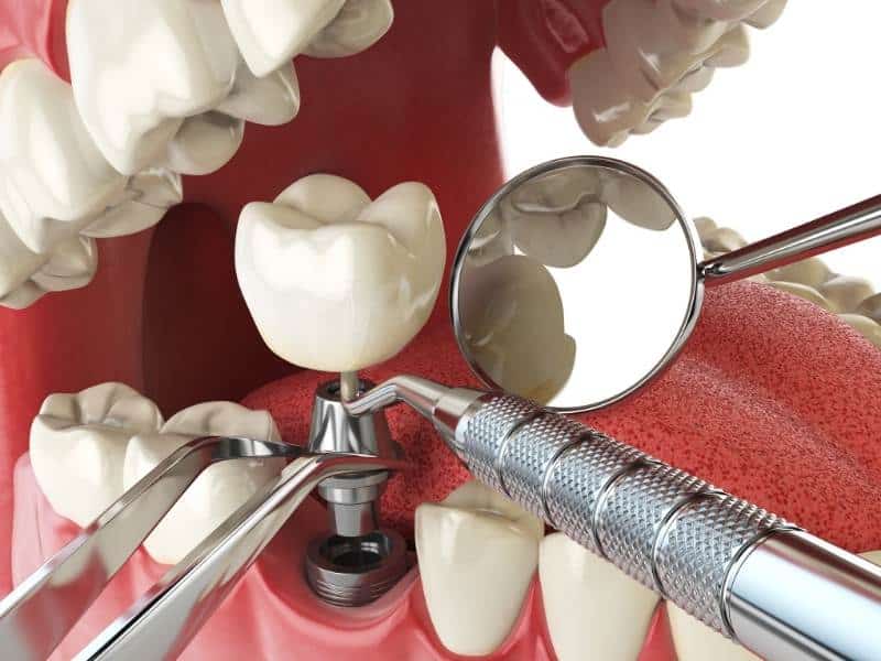 Example of a dental implant in Plano, TX